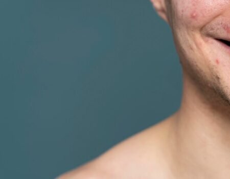 Can You Get Rid of Acne Scars
